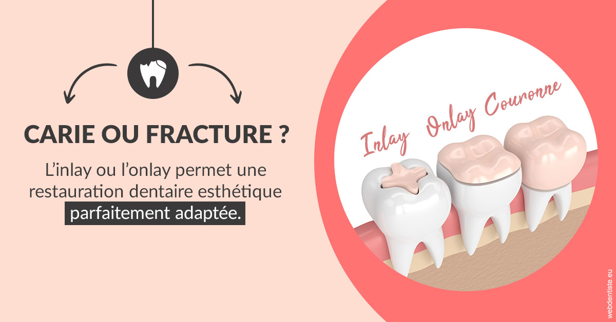 https://dr-eric-arvouet.chirurgiens-dentistes.fr/T2 2023 - Carie ou fracture 2