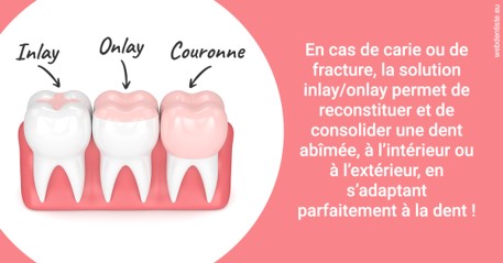 https://dr-eric-arvouet.chirurgiens-dentistes.fr/L'INLAY ou l'ONLAY 2